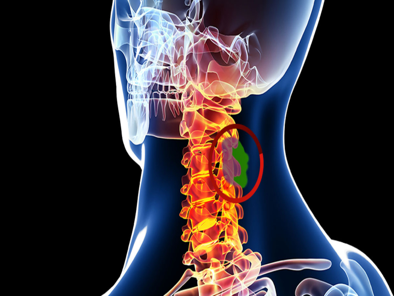 spine tumors