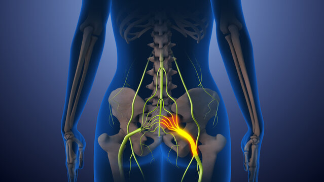 care for sciatica