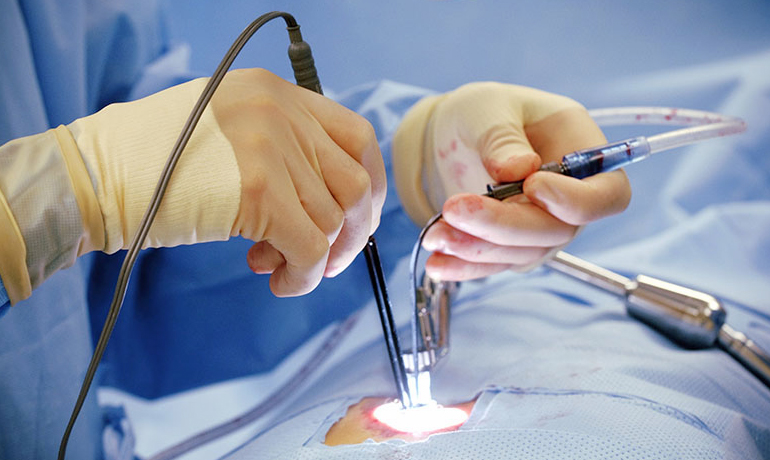 Micro Endoscopic minimally invasive spine surgery