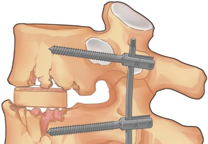 Surgical Intervention
