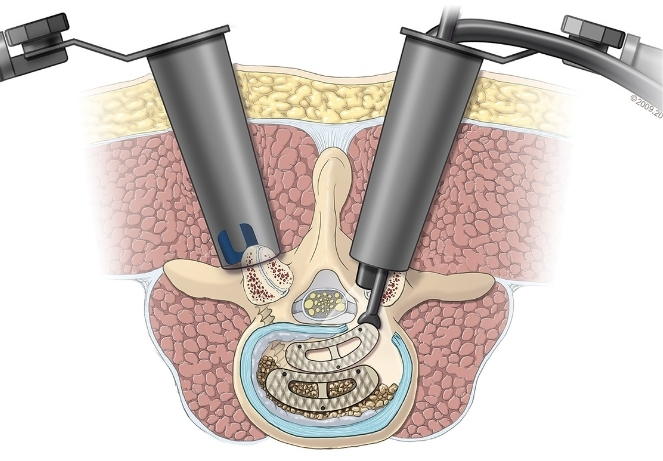 Transforaminal Lumbar Interbody Fusion
