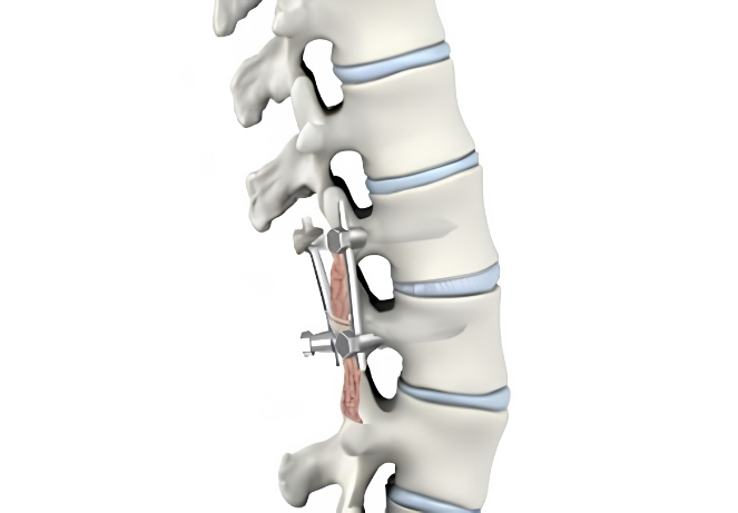 Posterior Lumbar Interbody Fusion
