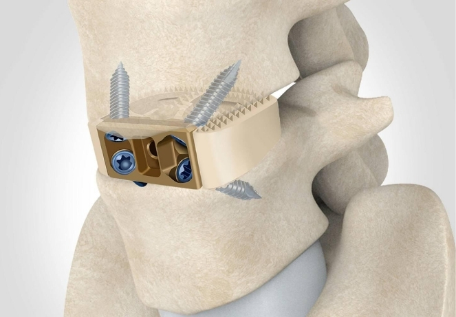 Anterior Lumbar Interbody Fusion