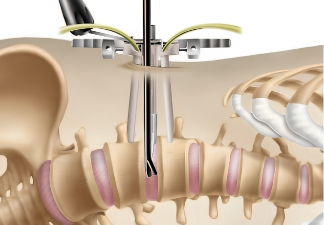 Extreme Lateral Interbody Fusion
