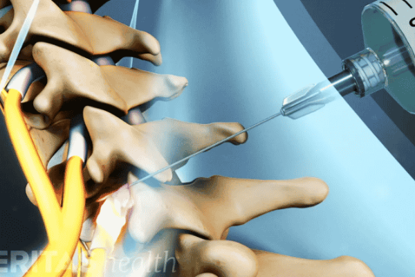 Transforaminal Nerve Root Block