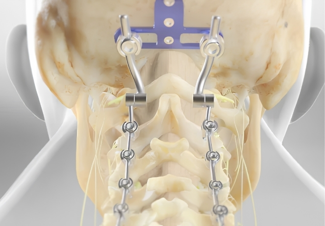 Posterior Cervical Fusion and Occipitocervical Fusion