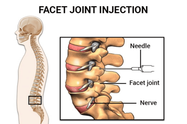 Facet Joint Injection