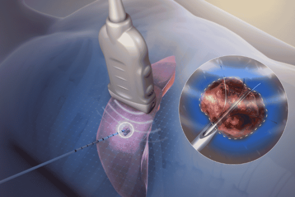 Radiofrequency Ablation