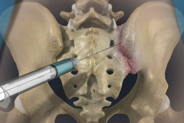 Sacroiliac Joint Injection