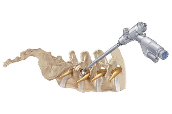 Minimally Invasive and Endoscopic Disc Surgery​
