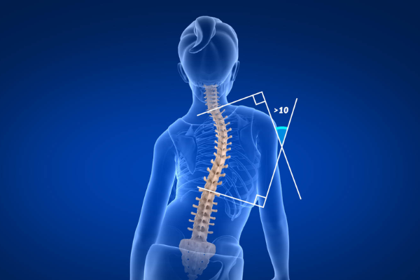 Idiopathic scoliosis​