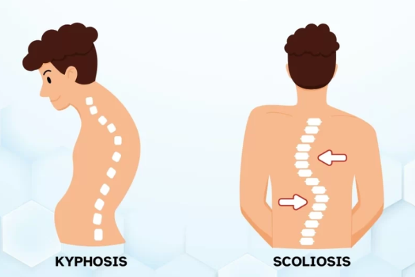 Degenerative scoliosis or kyphosis​