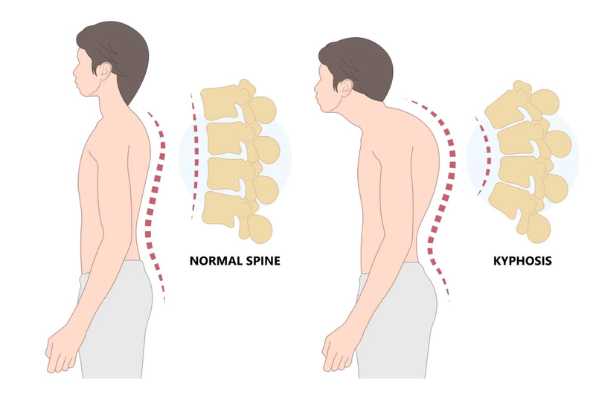 Postural kyphosis​
