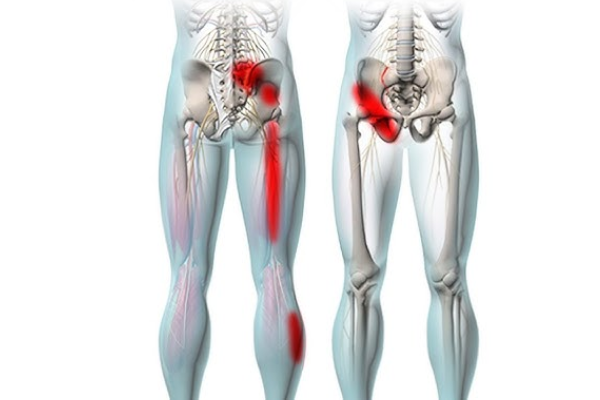 Sacroiliac joint pain​