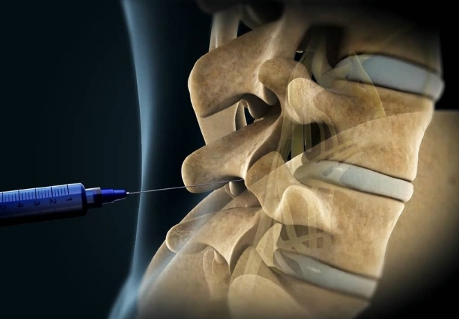 Image-Guided Spinal Injections