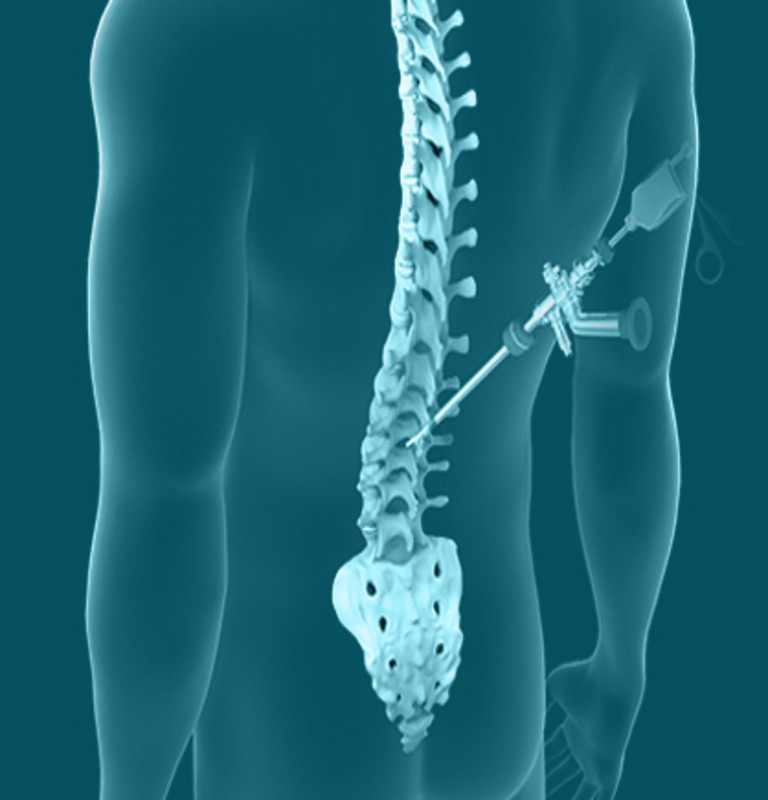 Full Endoscopic Minimally Invasive Spine Surgery