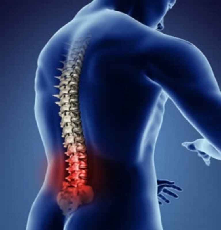 Lumbar Spondylosis
