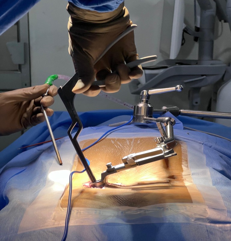 Minimally Invasive Spine Surgery