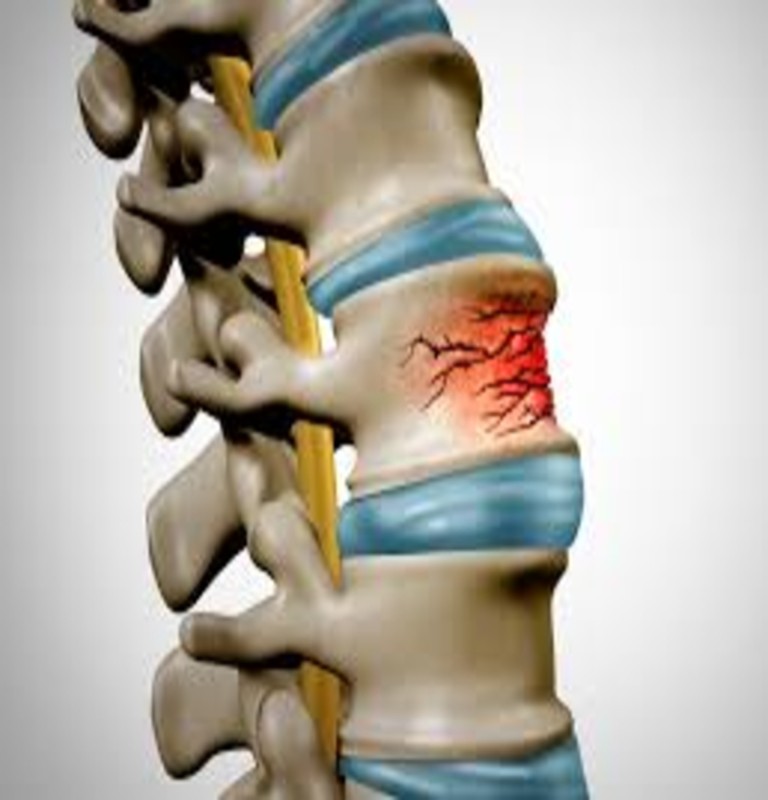 Spinal Fractures and Traumatic Injuries