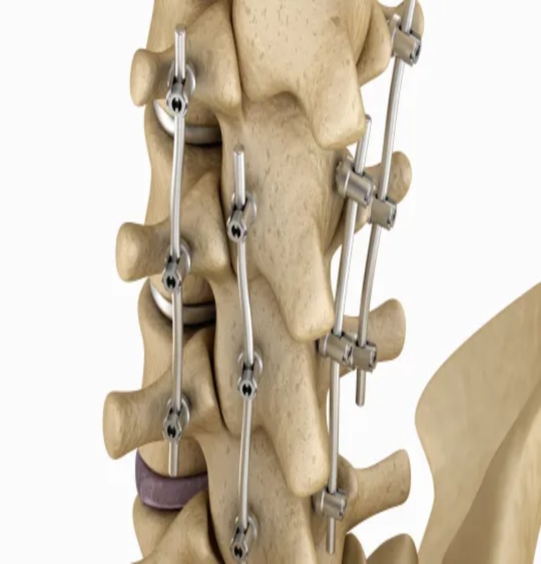Spinal Fusion
