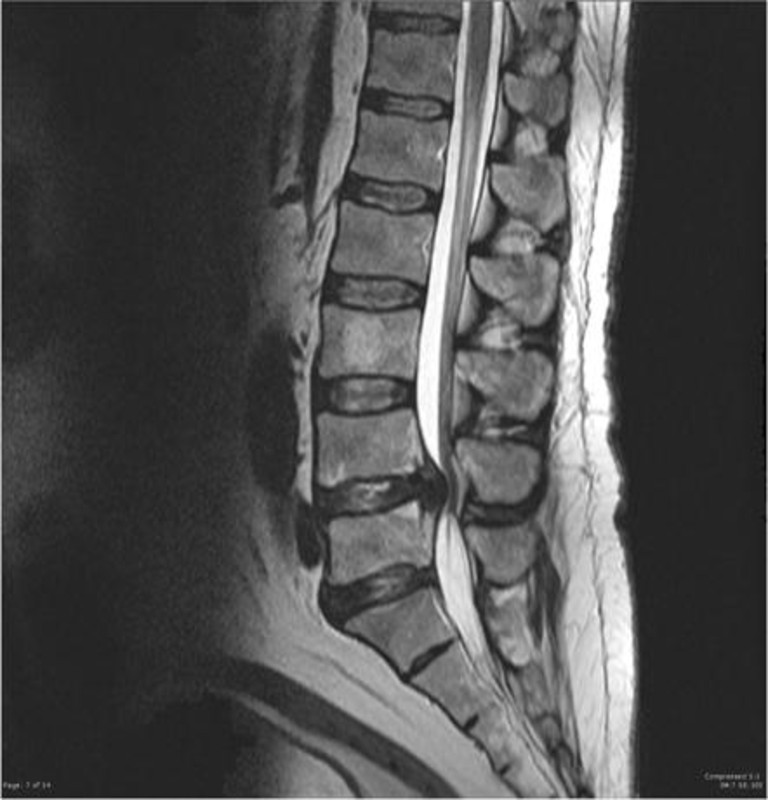Spinal Stenosis