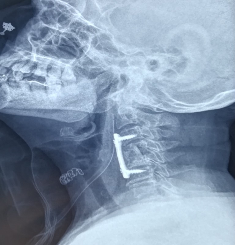 Spinal Tuberculosis