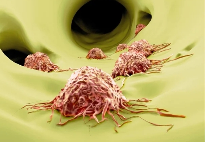 Metastatic Spine Tumors ​