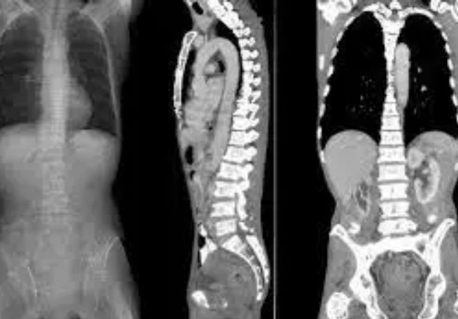 CT Scan
