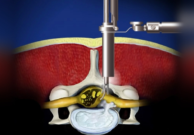 Micro Endoscopic Decompression / Discectomy