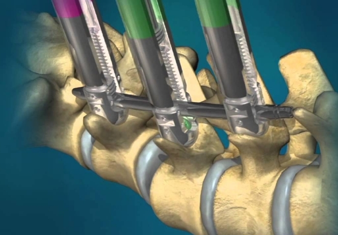 Percutaneous Pedicle Screw Fixation