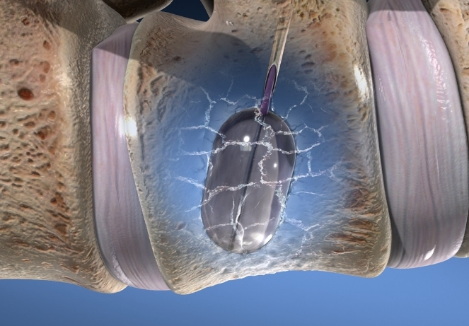 Balloon Kyphoplasty and Vertebroplasty