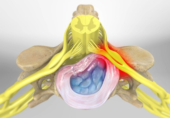 Lumbar Disc Herniation