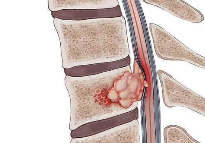 Primary Bone Tumors ​