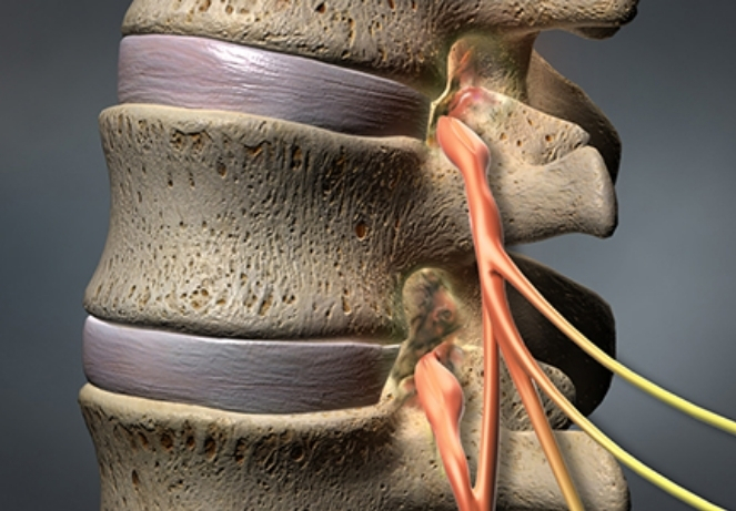 Lumbar Spinal Stenosis