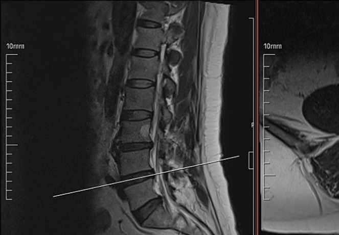 Foraminal and Far-Lateral Disc Herniation ​