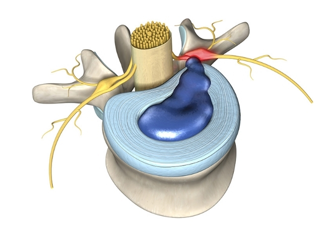 Cervical Disc Herniation ​