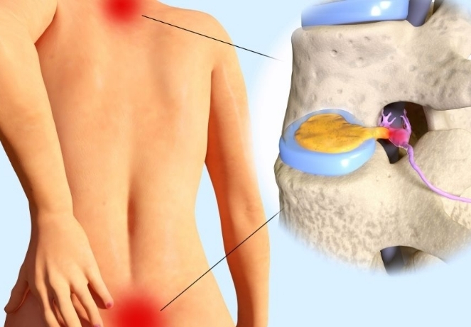 Recurrent Disc Herniation ​