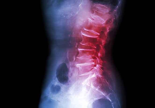 Epidural Fibrosis / Failed Back Surgery Syndrome