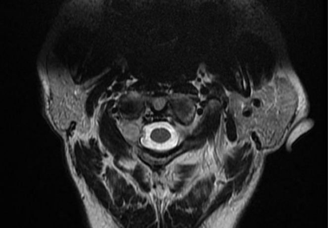 Nerve Sheath Tumors ​