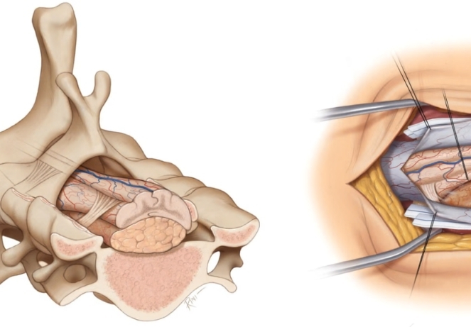 Meningiomas ​