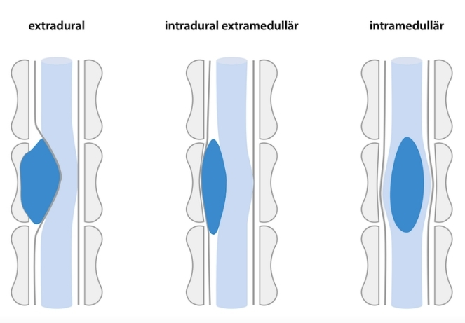 Intramedullary tumors ​