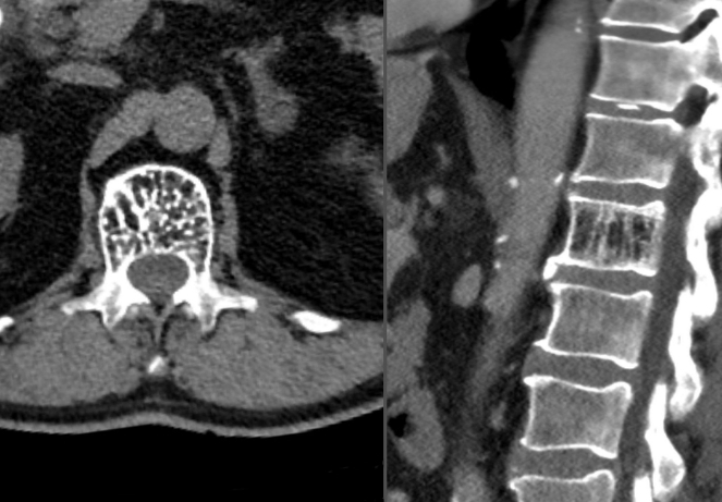 Hemangiomas ​