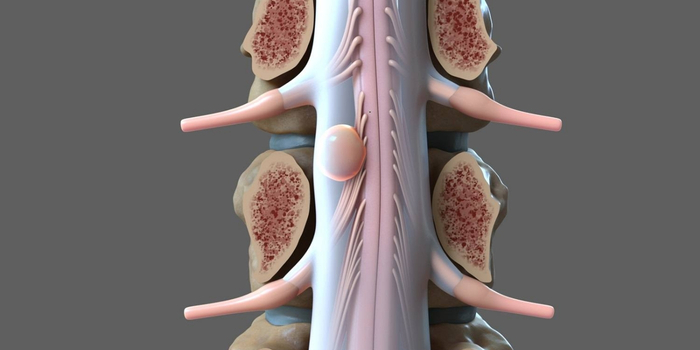 spine tumor