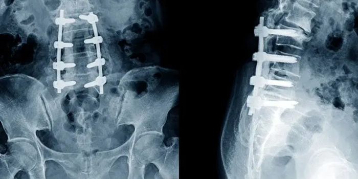 Spinal Fusion Surgery in Ahmedabad — What the Procedure Involves