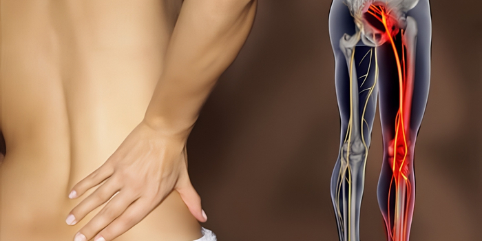 Understanding Sciatica and Its Causes