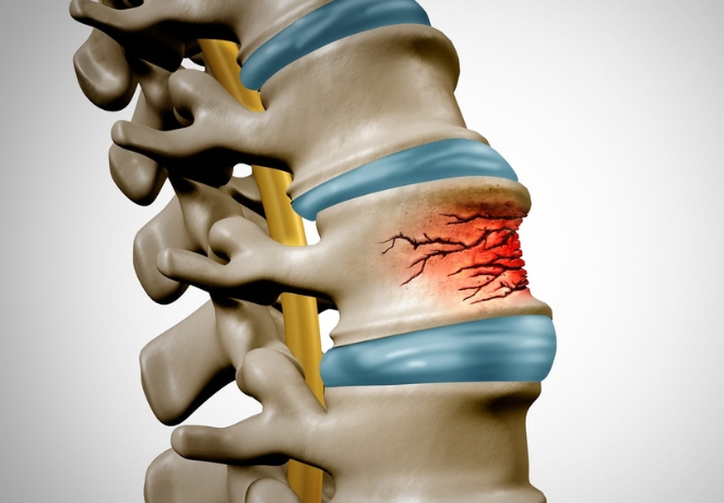 Degenerative Spine Changes