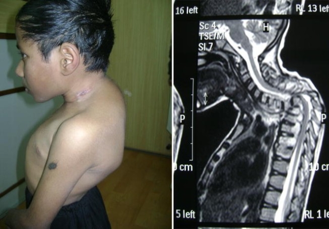 Progressive spinal involvement