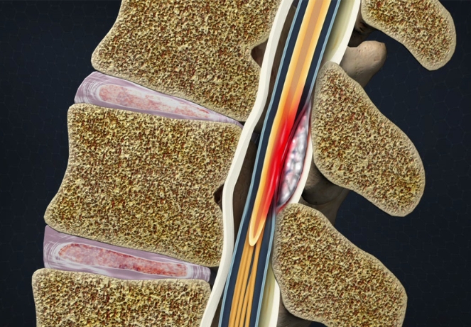Abscess formation
