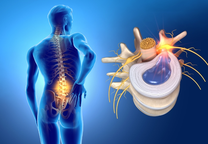 herniated disc