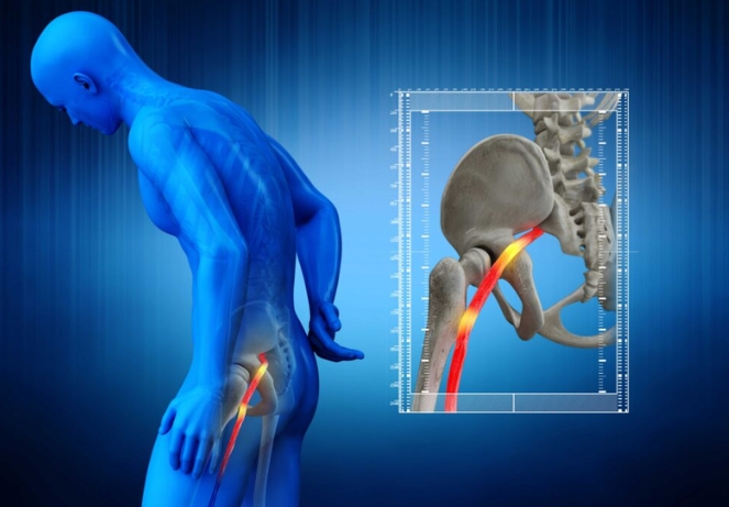 sciatic nerve pain